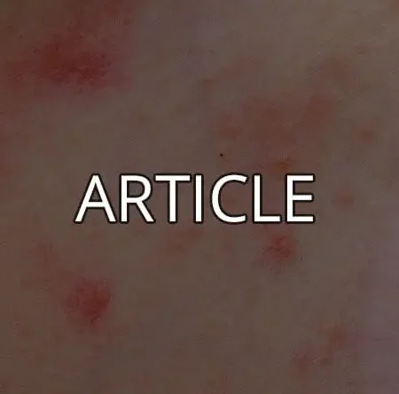 Psoriasis : aperçu, et l’atténuer par l’hypnose